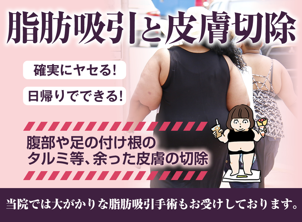 確実にヤセる！日帰りでできる！腹部や足の付け根のタルミ等、余った皮膚の切除。脂肪吸引と皮膚切除。当院では大がかりな脂肪吸引もお受けしております。