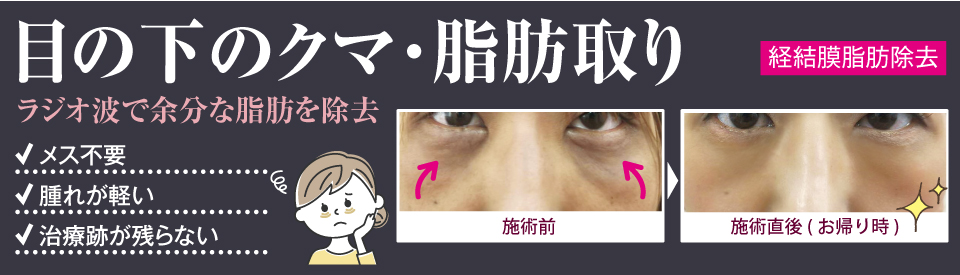 目の下のクマ・脂肪取り(経結膜脂肪除去)