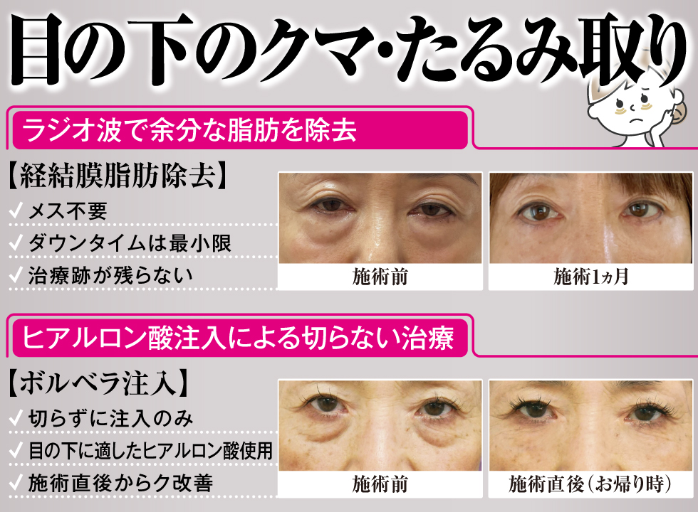 目の下のクマ・たるみ取り[目の下のクマ・たるみ取り][目の下のクマ・たるみ取り]