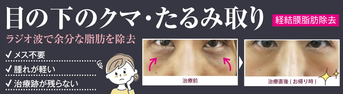 目の下のクマ・脂肪取り。ラジオ波で余分な脂肪を除去。