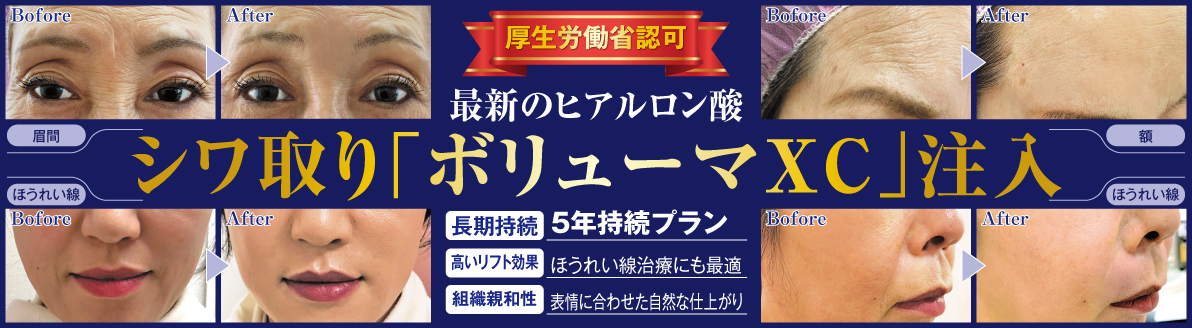 最新のヒアルロン酸注入「ジュビダームビスタ ボリューマXC」