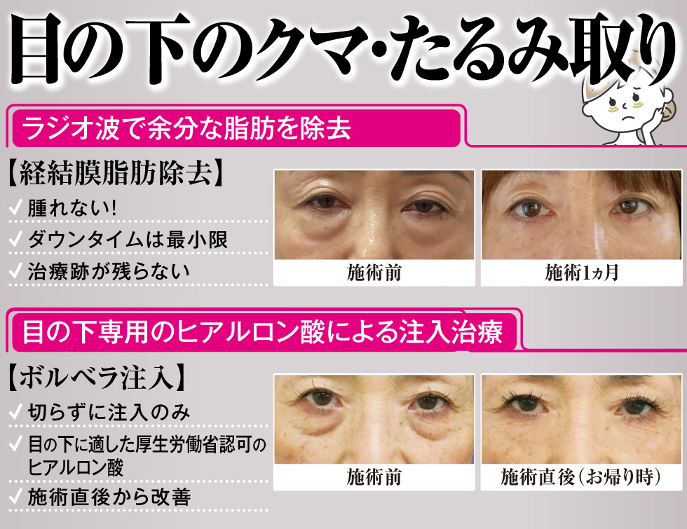 目の下のクマ・たるみ取り[目の下のクマ・たるみ取り][目の下のクマ・たるみ取り]