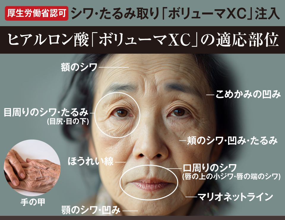 ヒアルロン酸「ボリューマXC」注入 | 診療科目 | <公式>あさひ ヒアルロン酸「ボリューマXC」注入 | 診療科目 | <公式>あさひ